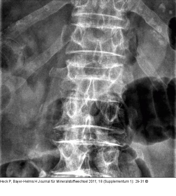 Lumbar vertebra