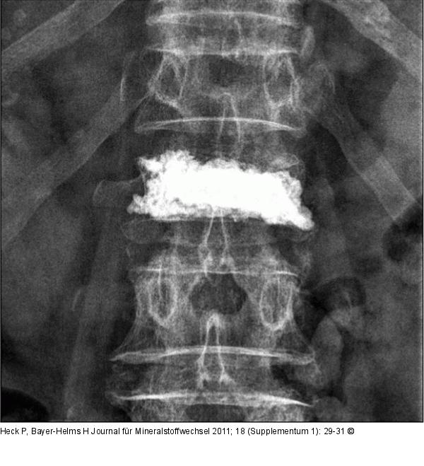 Lumbar vertebra