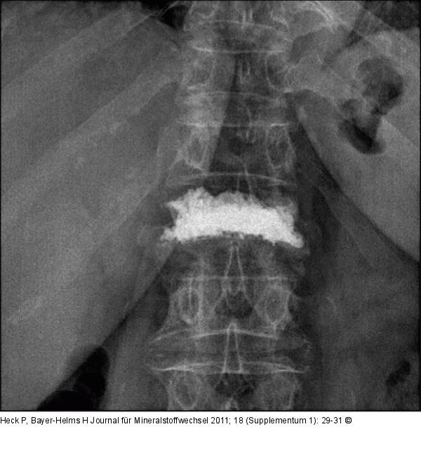 Lumbar vertebra