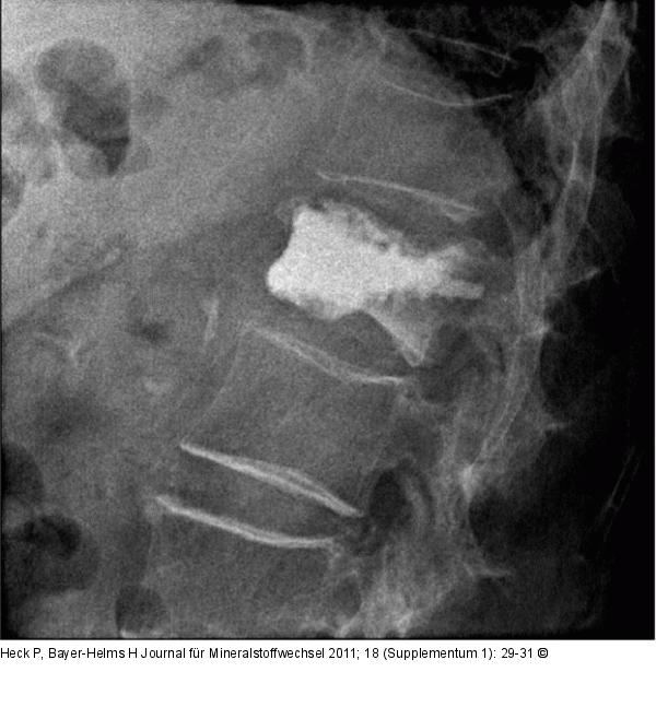 Lumbar vertebra