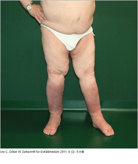 Chronisches Beinlymphödem nach 3 Wochen