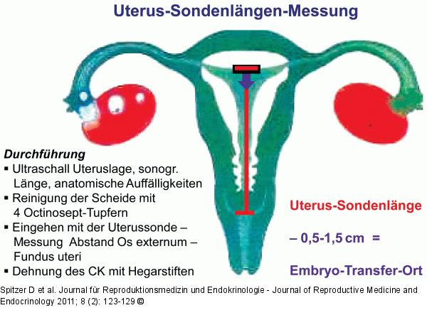 Uterus-Sondenlängen-Messung