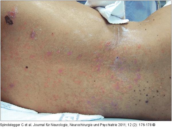 Epidermisabhebung