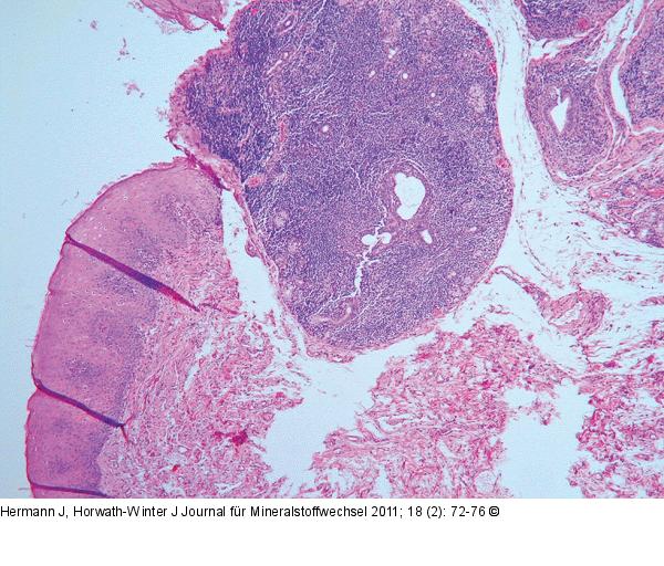 histologisches Bild Sjögren Syndrom