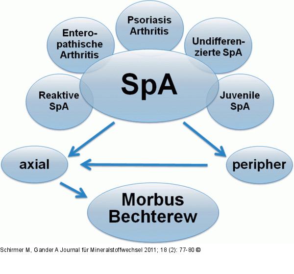 Beziehung zwischen Spondyloarthritis und Morbus Bechterew