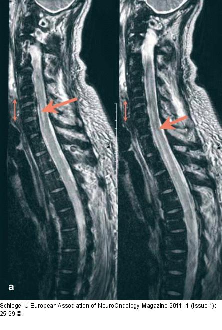 MRI