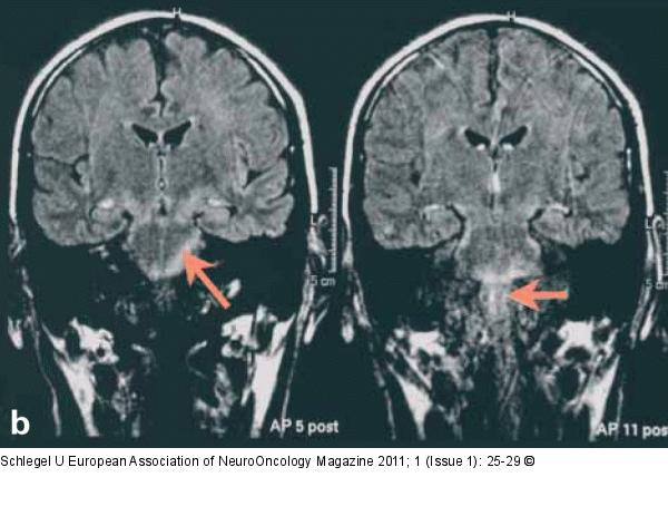 MRI