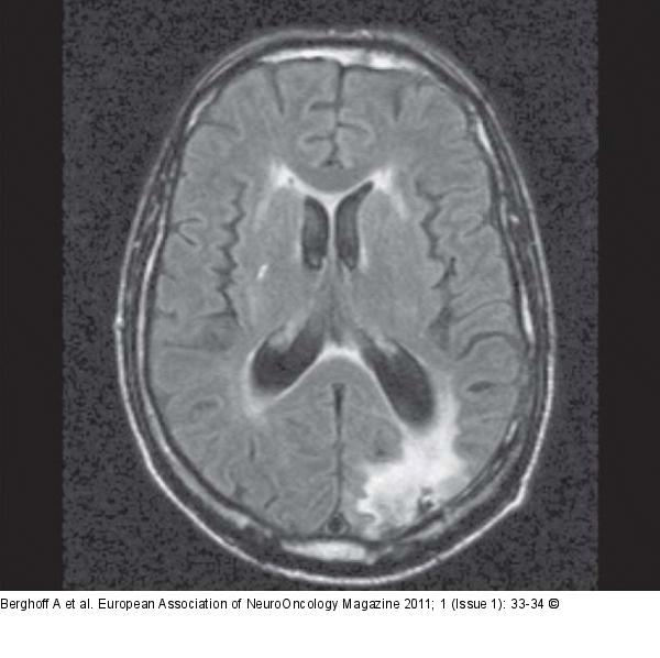 FLAIR-MRI