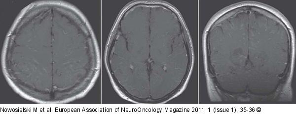 MRI