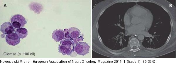 CSF-Cytology