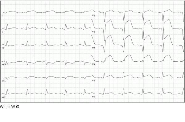 EKG