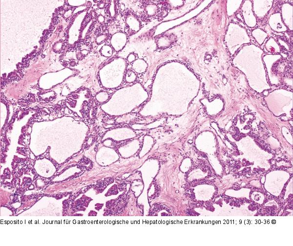 Neoplasie