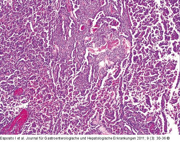 Neoplasie
