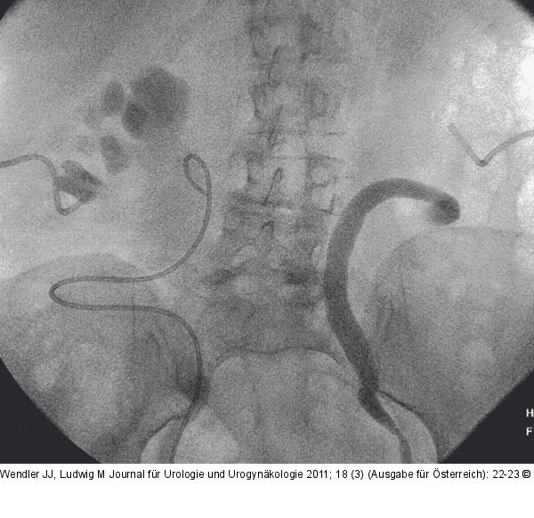 Ureteropyelographie