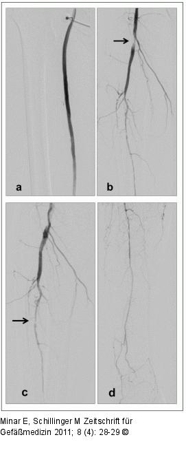 Antegrade Angiographie