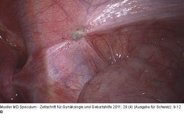 Peritoneale Endometriose