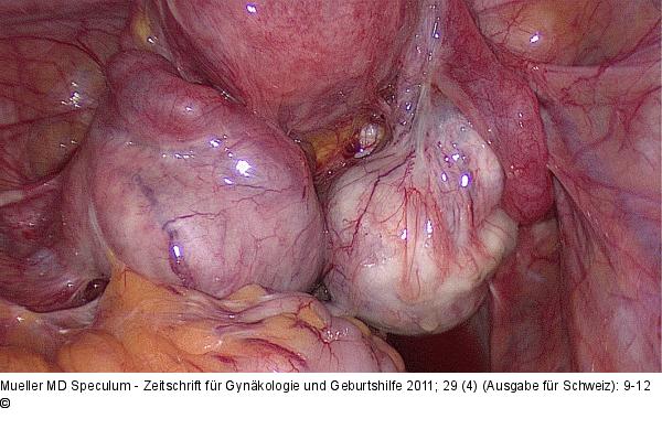 Ovarielle Endometriose