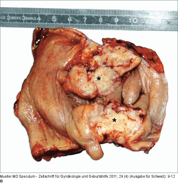 Darmendometriose