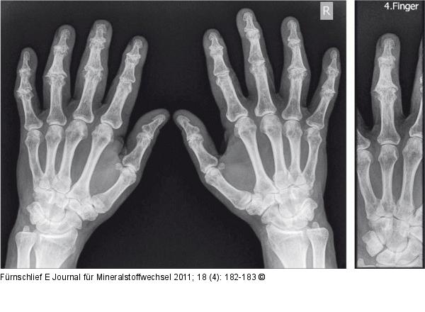 Arthrose