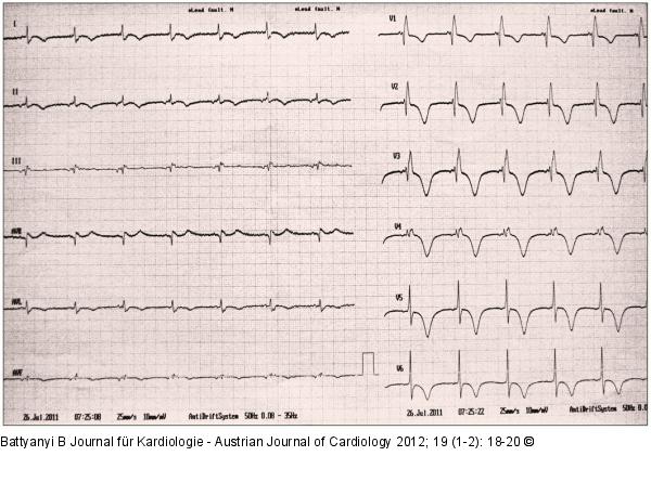 EKG