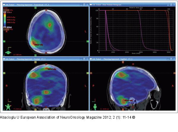 Brain Radiotherapy