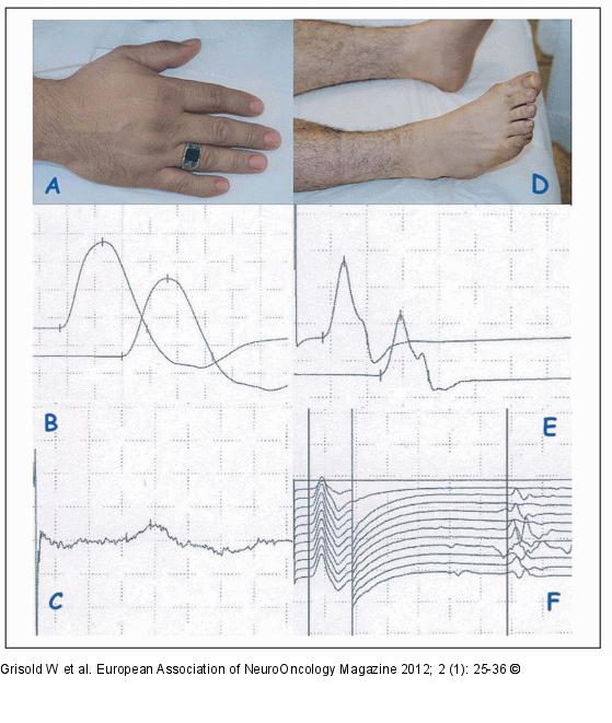 Cisplatinum neuropathy
