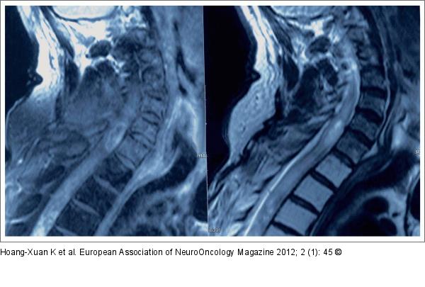 Thoracic Spinal Cord