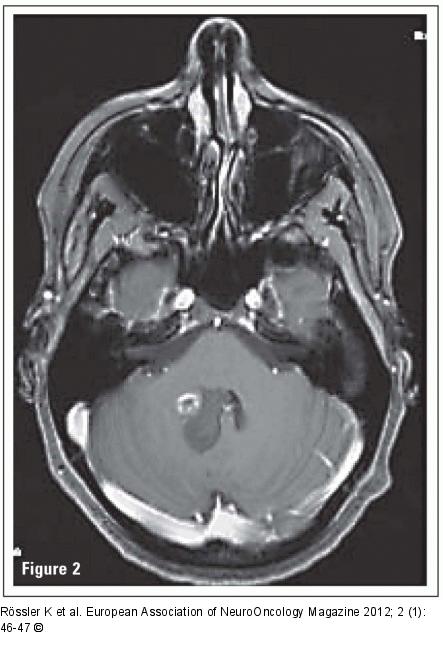 Brain Tumour