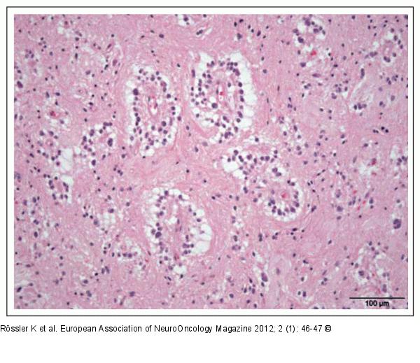 Brain Tumour  
