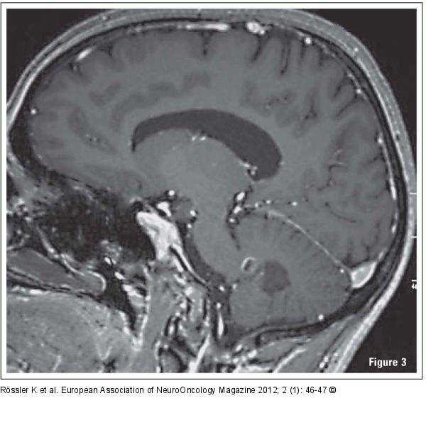 Brain Tumour