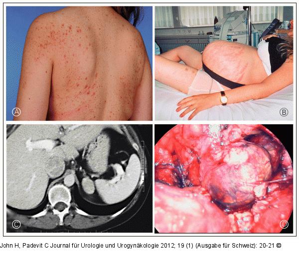 Cushing-Syndrom