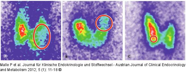 Schilddrüsentumor