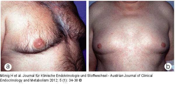Pseudogynäkomastie