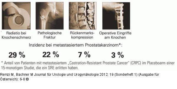Knochenmetastasen