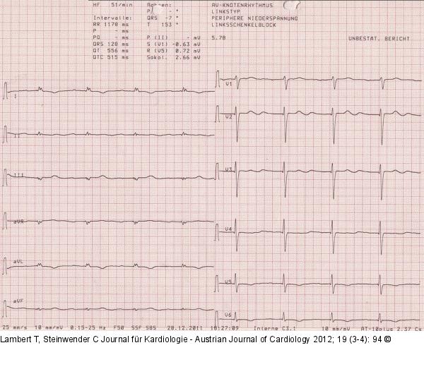 EKG