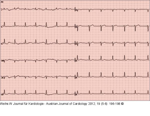 EKG