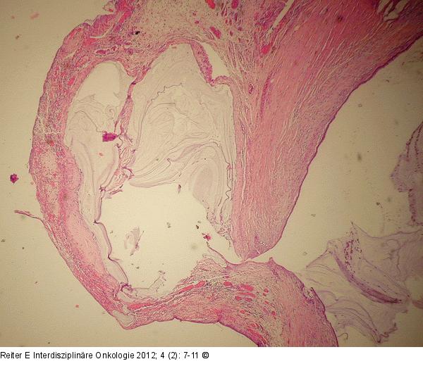 Appendix - Neoplasma
