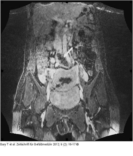 VCI - Thrombose