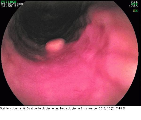 Tumor - Ösophagus