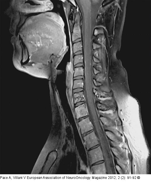 Spine