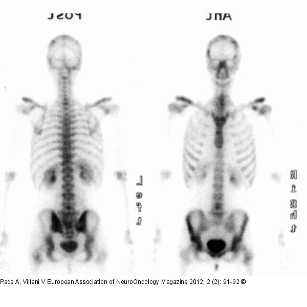 Skeletal involvement