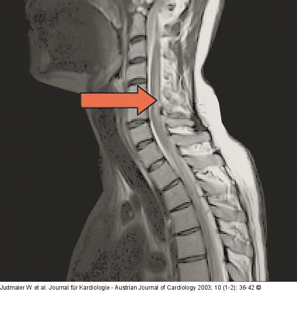 Spine