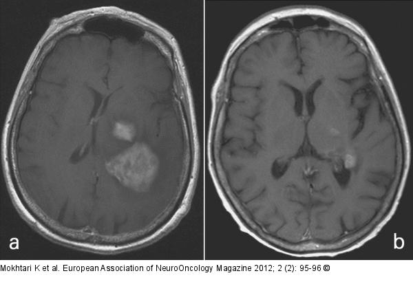 Gadolinium Injection