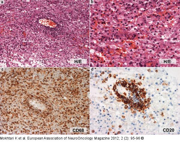 Brain biopsy