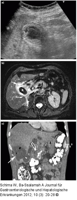 Cholecystis