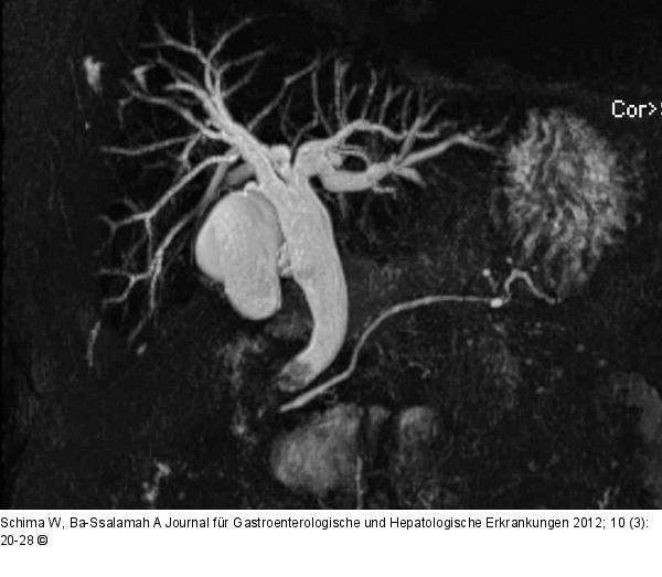 Choledocholithiasis