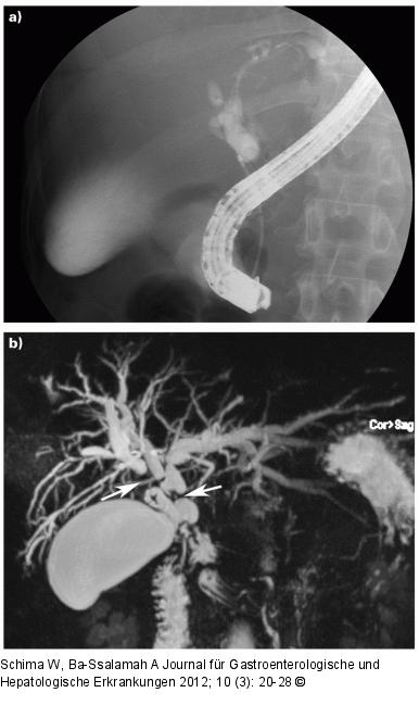 Cholangitis
