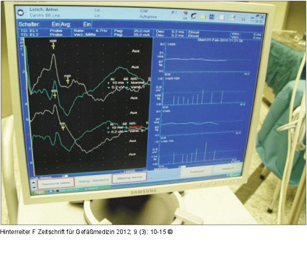 Hirnmonitoring