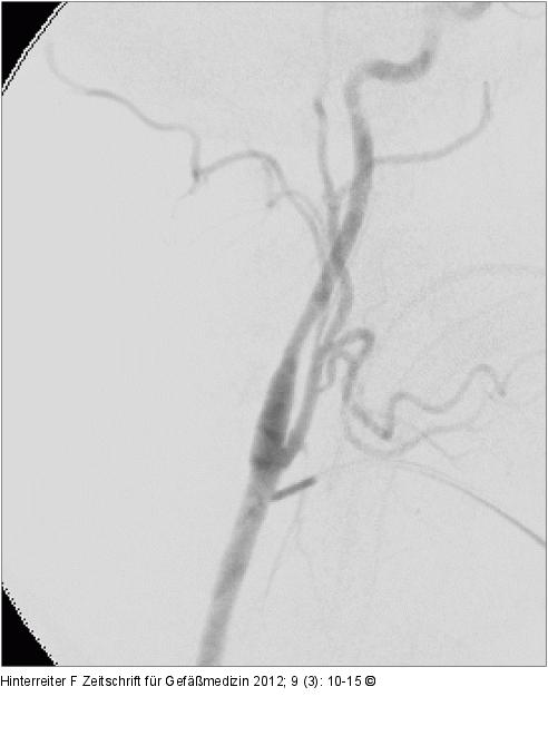 Angiographie