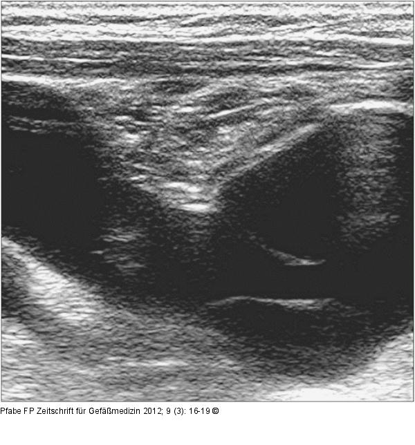 Aneurysma